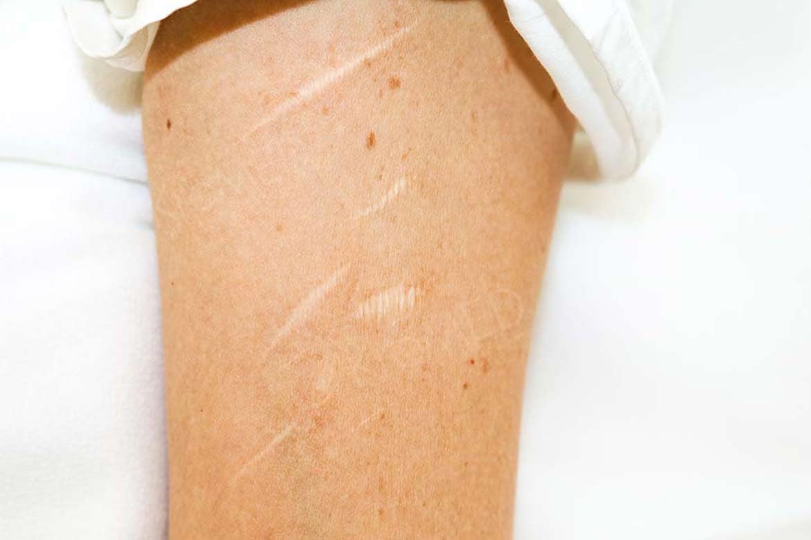 KroMED | medizinisch ästhetische micro Pigmentierung 6 kromed narben camouflage ritznarben permanent make up NA CA