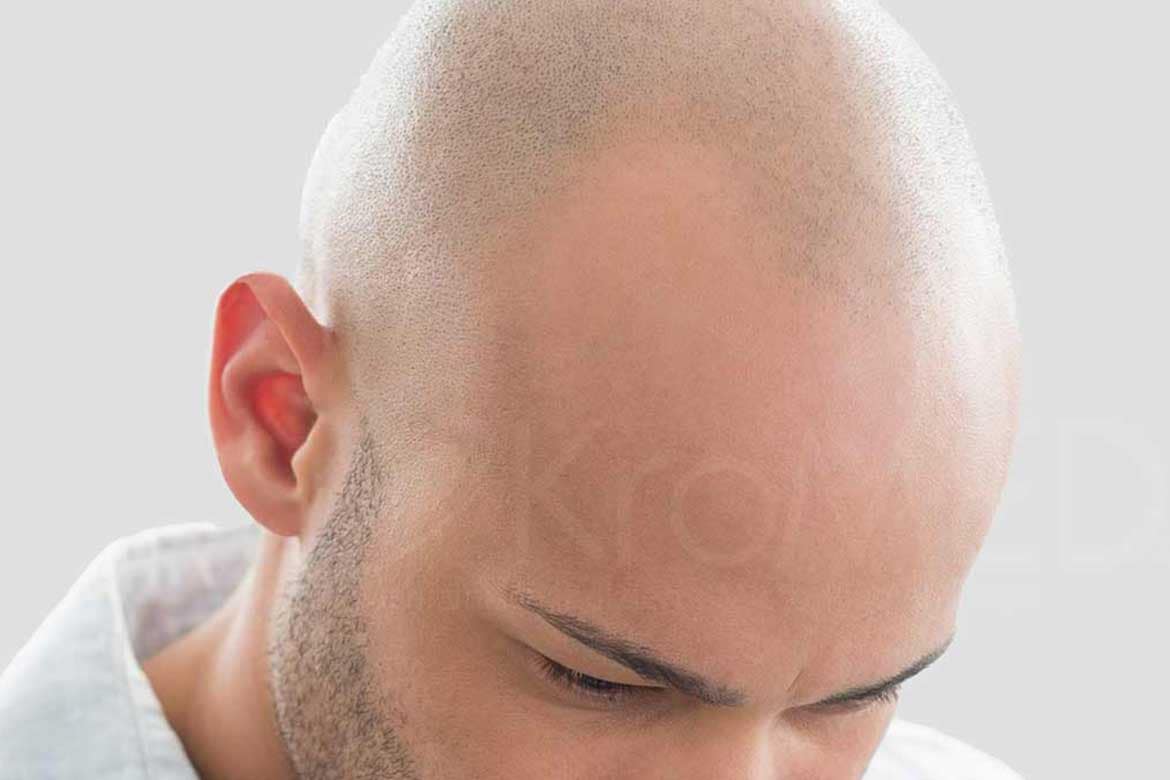 KroMED | medizinisch ästhetische micro Pigmentierung 8 kromed haarpigmentierung hamburg Kopfhautpigmentierung tattoo permanent make up mHP