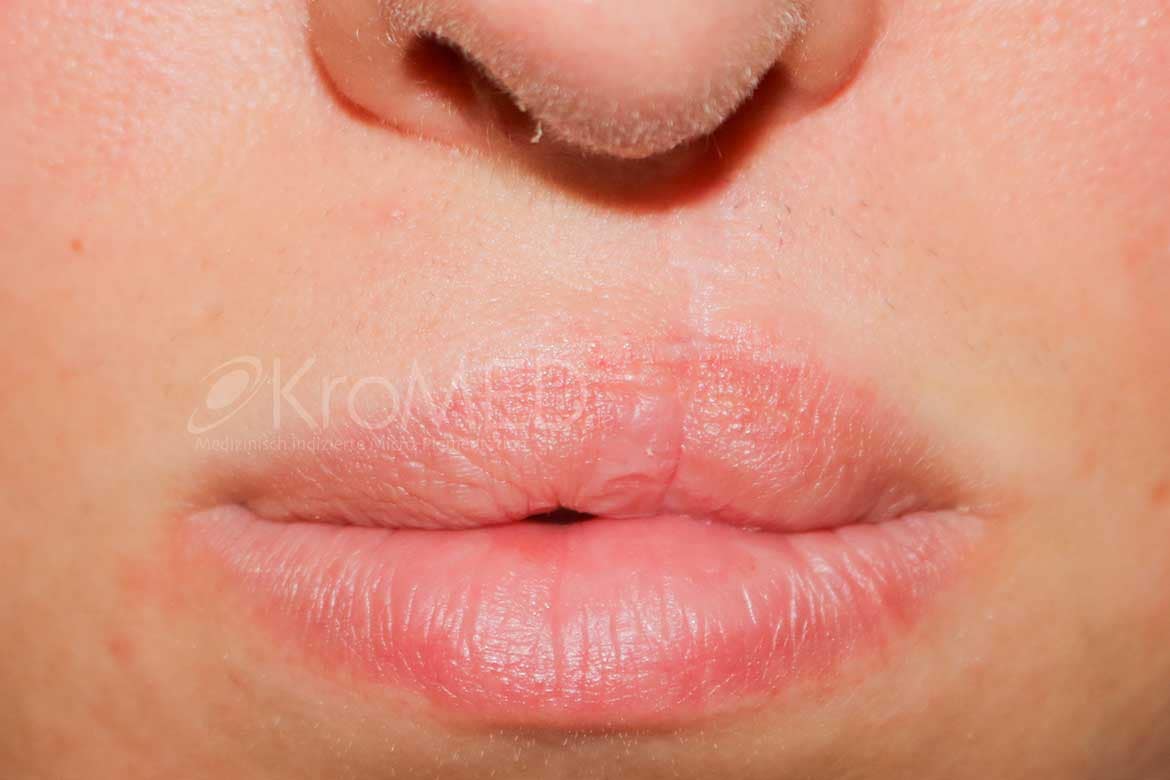 KroMED | medizinisch ästhetische micro Pigmentierung 7 kromedl ippengaumenspalte oberlippenkorrektur permanent make up mann frau kind LKGS