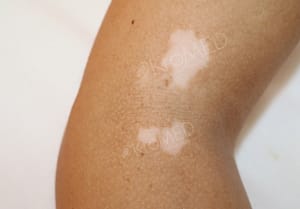 Narben Camouflage 7 vitiligo pigmentstoerung camouflage kaschieren permanent medizinisch KroMED