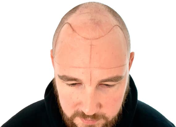 KroMED | micro Haarpigmentierung Hamburg statt Haartransplantation in der Türkei KroMED | micro Haarpigmentierung Das Bild zeigt einen Mann mit Halbglatze, dessen Kopf symmetrisch mit Linien vorgezeichnet wurde. Diese Linien dienen zur Orientierung für eine Micro Haar Pigmentierung (MHP), eine Technik zur Simulation von Haarstoppeln. Die Haarlinie, die gezeichnet wurde, repräsentiert eine mögliche künftige Haaransatzinitiierung. Es ist erkennbar, dass der Kunde möglicherweise einen höheren Haaransatz wünscht, da die vorgezeichnete Linie relativ weit unten auf der Stirn beginnt. Die Symmetrie der Linien ist offensichtlich, was darauf hindeutet, dass die Pigmentierung sorgfältig geplant wird, um ein natürliches Ergebnis zu erzielen. Die richtige Position des Haaransatzes ist jedoch eher tiefer als die gewünschte. Haarpigmentierung, auch bekannt als Scalp Micropigmentation (SMP), hat in den letzten Jahren an Popularität gewonnen. Was ist micro Haarpigmentierung? Bei der micro Haarpigmentierung handelt es sich um ein kosmetisches Verfahren, bei dem spezielle Pigmente in die oberste Hautschicht der Kopfhaut eingearbeitet werden. Dies geschieht durch präzise Nadelstiche, die kleine Punkte erzeugen, die den Look von Haarfollikeln imitieren. Das Ergebnis ist ein natürlicher, rasierter Look, der das Gefühl von dichterem Haarvermittelt.