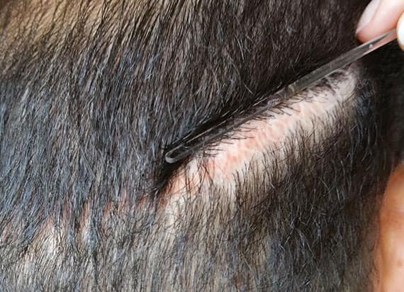 KroMED | micro Haarpigmentierung _Narbe nach FUT_Steifenentnahme KroMED | micro Haarpigmentierung Hamburg. Das Bild stellt das Ergebnis einer früheren Haartransplantation, bei der eine sogenannte Streifenentnahme (FUT - Follicular Unit Transplantation) durchgeführt wurde dar. Bei dieser Methode wird ein Streifen Haut von der Kopfhaut entfernt, was eine Narbe hinterlässt, die durch das Haar kaschiert werden kann, aber in diesem Fall sichtbar ist. Eine micro Haarpigmentierung, auch SMP genannt, könnte in diesem Fall eine Option sein, um die Narbe weniger auffällig zu machen, indem Pigmente in die Narbe eingebracht werden, um sie farblich an die umgebende Kopfhaut und das Haar anzupassen