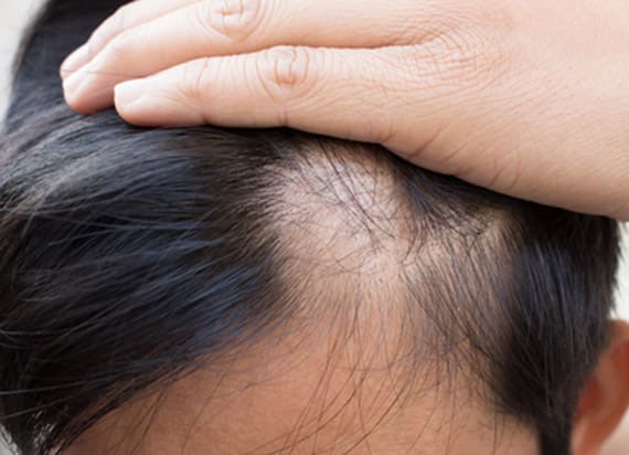 KroMED | micro Haarpigmentierung kreisrunder Haarausfall hormonbedingt Frau Mann dunkler machen KroMED | micro Haarpigmentierung Hamburg - Hoffnung bei kreisrundem Haarausfall Denn was würde im Falle einer Alopecia #areata #universalis (Ausfall aller Körperhaare) passieren, wenn die #Augenbrauen wesentlich zu hoch oder zu tief rekonstruiert - repigmentiert werden? Im Fall des Nachwachsens der Härchen, des erneuten Haarwachstums, wenn die Augenbrauen also wieder kommen ... hätten sie die echten Augenbrauenhärchen versetzt ... doppelt ... höher oder tiefer... Um diesen Fall zu vermeiden, suchen Sie frühzeitig ein Beratungsgespräch bei einem spezialisierten, #medizinischen Micropigmentisten.