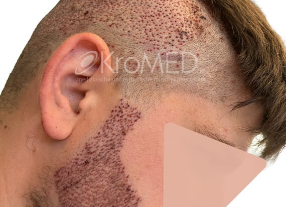 KroMED | micro Haarpigmentierung Hamburg _luecken_fuellen_bart_haartransplantation_spenderbereich_mHP KroMED | micro Haarpigmentierung Hamburg | Die Pflege für den modernen, anspruchsvollen Mann geht inzwischen weit über die konservative Männerkosmetik hinaus. Männer fahren mit ihrem Haarausfall quer durch Europa auf der Suche nach den besten Kliniken für Haartransplantationen, Eigenhaarverpflanzungen, Haaransatz Initiierung um ihre kahlen Stellen auf dem Kopf mit eigenen, kleinen Haarfolikeln wieder auffüllen zu lassen. Die Methoden dazu sind vielfältig. Sie nennen sich FUT, FUE, Streifenentnahme, Grafts, Minigrafts oder Micrografts Haartransplantationen. Hierbei werden aus Spenderarealen kleinen Haarinseln entnommenen. Jeweils nach angewandter Methode, hinterlässt jede Entnahme eine größere oder kleinere haarlose Stelle. Diese Kopfhautareale lassen kein Eigenhaar wieder wachsen. Die Stärke der individuell, körpereigenen Hautpigmentierung, helle oder dunklere Haut, lassen die Narben der Spenderareale unterschiedlich klar hervortreten. An dieser Stelle bietet nun die micro Haar-Repigmentierung eine Ergänzung, einen Ausgleich ganz ohne chirurgischen Eingriff oder Hormonbehandlung. Das Wissen um diese Tatsache ist für manchen Kunden eine Entscheidungshilfe. Wenn Sie mehr über Haarpigmentierung bei androgenetischer Alopezie & Alopecia Areata wissen möchten lassen Sie sich beraten ....