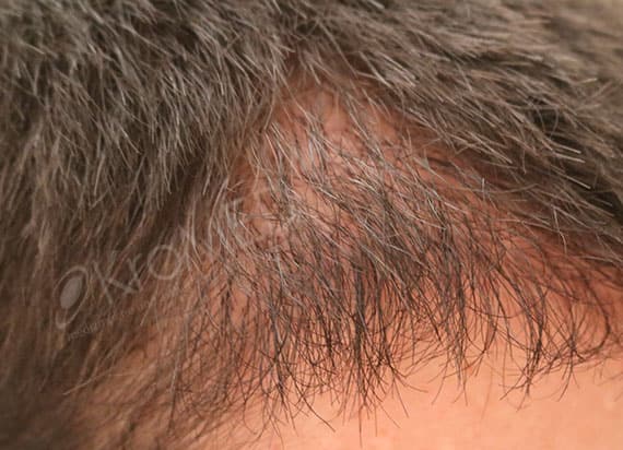 KroMED | micro Haarpigmentierung Hamburg – nach Haartransplantation Geheimratsecken verdichten mHP KroMED | micro Haarpigmentierung Hamburg, Oftmals reicht eine #Haartransplantation, zur Auffüllung ihrer #Geheimratsecken nicht aus. Eine #microHaarPigmentierung kann hier sehr gut Abhilfe leisten. Die #kahlenStellen, die noch durchschimmernde #Kopfhaut wird durch micro Haar Pigmentierung aufgefüllt und kaschiert durch den „dunkleren Schein“, ihre nunmehr neuen „nicht mehr sichtbaren“ Geheimratsecken.