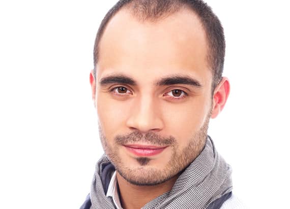 KroMED | micro Haarpigmentierung – lichte Haare und Geheimratsecken KroMED | micro Haarpigmentierung – wie Geheimratsecken permanent kaschieren- schraffierte Haarverdichtung wenn die Haare schütter werden. Geheimratsecken sind meist erste Anzeichen für natürlichen und anlagebedingten Haarausfall. Es ist auch nicht regelhaft, dass die Haarausdünnung im Stirnbereich oder über den Schläfen beginnt. Schütteres Haar kann genauso gut am Oberkopf beginnen und zunehmend an Haardichte abnehmen bis hin, dass durch das lichte Haar die Kopfhaut hell hervor scheint. Wer genetisch veranlagt sagen kann, dass er mit hoher Wahrscheinlichkeit nur die Haare des Oberkopfes verlieren wird, den dichten Haarkranz aber behalten wird, kann die Überlegung einer Haarverdichtung durch Haartransplantation in Betracht ziehen. Auch hier erwähne ich erneut, dass die Anzahl des Eigenhaares begrenzt ist. Dort wo es entnommen wird, verbleiben je nach Haarentnahme-Technik helle, freie, haarlose Stellen. Hier kann durch uns eine Haaransatzinitiierung, micro Haar Tätowierung bzw. micro Haar Pigmentierung (Kopfhautpigmentierung) durchgeführt werden. Micro Haarpigmentierung bedeutet das Vorhandensein an micro Haarwurzeln durch kleinste Farbpünktchen vorzutäuschen. Die Intensität dieser Haarpigmentierung lässt mit zunehmender aber relativ unbestimmter Zeit nach. Verantwortlich für den Verblassungsprozess dieser Mikropunkte sind unser eigener Stoffwechsel aber auch unsere Lebensgewohnheiten. Wie sie Ihre Haartätowierung pflegen, erfahren Sie in einem ausführlichen Vorgespräch. Fragen Sie nach und nutzen Sie Ihr erstes, ausführliches, unverbindliches Beratungsgespräch. KroMED ist das Fachstudio für medizinisches Permanent Make-up, medizinische Micropigmentation und micro Haarpigmentierung - in Hamburg. Wir freuen uns auf Sie.