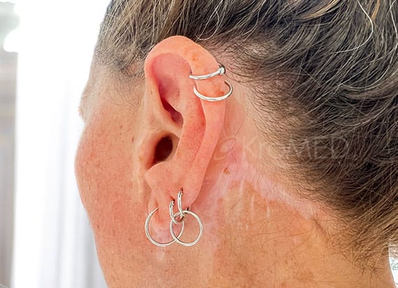KroMED | Liftingnarbe Facelift Narben Camouglage in Hamburg KroMED | ästhetische Fachpraxis für Liftingnarben-Camouflage. Die Abbildung zeigt eine Liftingnarbe hinter dem Ohr, die durch medizinische Pigmentierung kaschiert werden kann. Nach einem Facelift oder ähnlichen Eingriffen entstehen häufig Narben entlang des Haaransatzes, die durch Nähen oder Klammern fixiert wurden. In diesem Fall ist die Narbe leicht gerötet und hat einen breiten, weißen Bereich, der auf eine gedehnte oder „gerissene“ Heilung hindeutet. Spuren der Naht oder Klammern sind entlang der Narbe erkennbar. Durch eine Narbencamouflage, eine spezielle Form der medizinischen Pigmentierung, können solche sichtbaren Narben kaschiert werden. Hierbei wird eine hautähnliche Pigmentfarbe verwendet, um die Narbe optisch an die umliegende Haut anzupassen. Die Camouflagepigmentierung gleicht Farbunterschiede aus und hilft, die Narbe weniger auffällig erscheinen zu lassen. Der Vorteil dieser Methode ist, dass sie dauerhaft ist und das Selbstbewusstsein des Patienten steigern kann. Besonders bei auffälligen Narben im sichtbaren Bereich wie hinter den Ohren ist diese Technik hilfreich, um natürliche Ergebnisse zu erzielen.