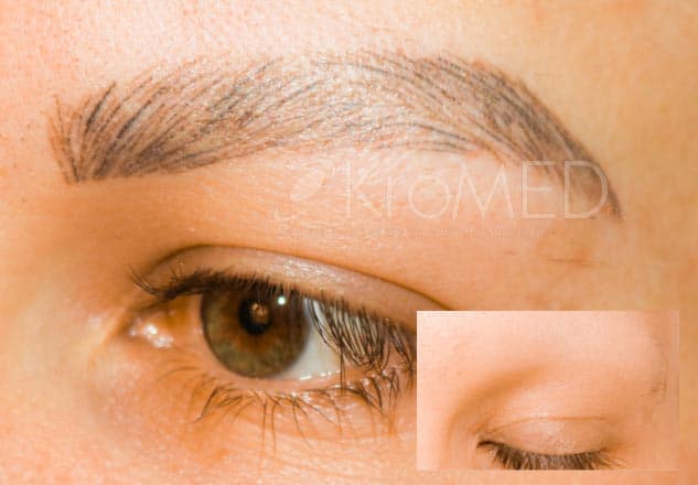 KroMED | Vorher-Nacher Bild Augenbrauen, Alopecia totalis, kompletter Haarverlust KroMED | Permanent Make-up Augenbrauen Diamant Blading, Alopecia totalis,Vorher-Nacher. Das Bild zeigt eine Vorher-Nachher-Darstellung der Augenbrauenbehandlung bei Alopecia totalis. Rechts, im kleinen Bildausschnitt sieht man die Augenbrauen vor der Behandlung, komplett kahl und ohne sichtbare Härchen, was für diese Erkrankung typisch ist. Nach der Anwendung der Hair by Hair-Technik mittels Diamant Blading wirkt die Augenbraue im größeren Bild täuschend echt und natürlich. Die feine Härchenzeichnung sorgt für einen präzisen, individuellen Look, der ideal ist, um den Haarverlust bei Alopecia oder Trichotillomanie auszugleichen. Diese Methode von KroMED bietet eine dauerhafte Lösung für lückenhafte oder fehlende Augenbrauen durch Permanent Make-up. Jede einzelne Braue (browse) wird sorgfältig rekonstruiert, sodass die Ergebnisse besonders natürlich wirken und das Selbstbewusstsein der Betroffenen gestärkt wird.