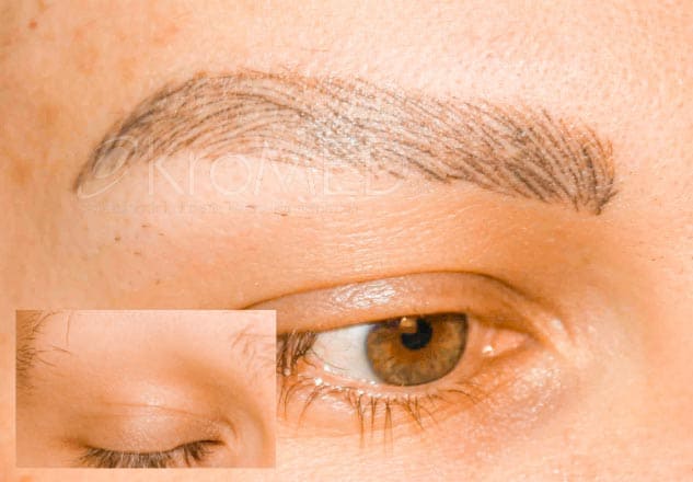 MED | Vorher-Nachher_Permanent_Make-up_Augenbrauen_Diamant_Blading KroMED | Augenbrauen – Alopecia - kein Mikroblading – Diamant Blading - Permanent Make-up. Das Bild zeigt eine Vorher-Nachher-Darstellung einer Augenbrauenbehandlung. Im kleinen eingeblendeten Ausschnitt links ist der Zustand der Augenbraue vor der Behandlung zu sehen: spärlich, dünn und mit kaum sichtbaren Härchen. Dies deutet auf Augenbrauenprobleme hin, möglicherweise aufgrund von Alopecia oder Trichotillomanie. Der größere Bereich zeigt das Nachher-Ergebnis nach der Anwendung von Diamantblading oder permanenten Augenbrauenhärchenzeichnungen. Die feinen, semipermanent gezeichneten Härchen wirken täuschend echt und natürlich. Diese permanentmakeupeyebrows-Technik verleiht der Augenbraue Fülle und Definition, ohne künstlich auszusehen. Dank der Präzision der Diamantblading-Methode sind die Härchen so fein, dass sie kaum von natürlichen Augenbrauen zu unterscheiden sind.